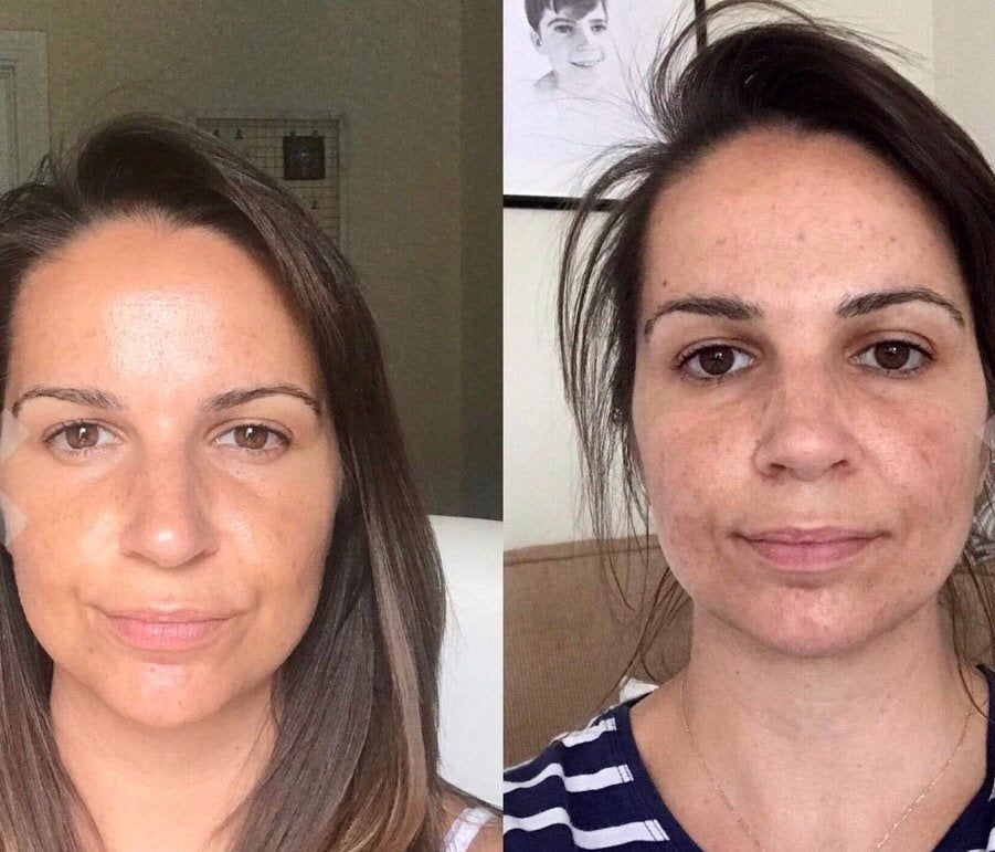 kojic before and after